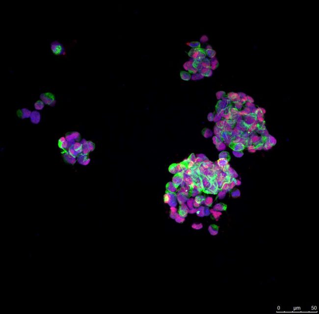 Imagen de microscopía de fluorescencia de células de glioblastoma creciendo en forma de agregados (Gliomalab)