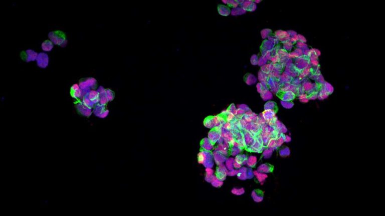 Imagen de microscopía de fluorescencia de células de glioblastoma creciendo en forma de agregados (Gliomalab)